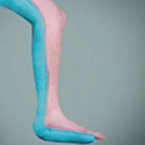 Legs Fixation
